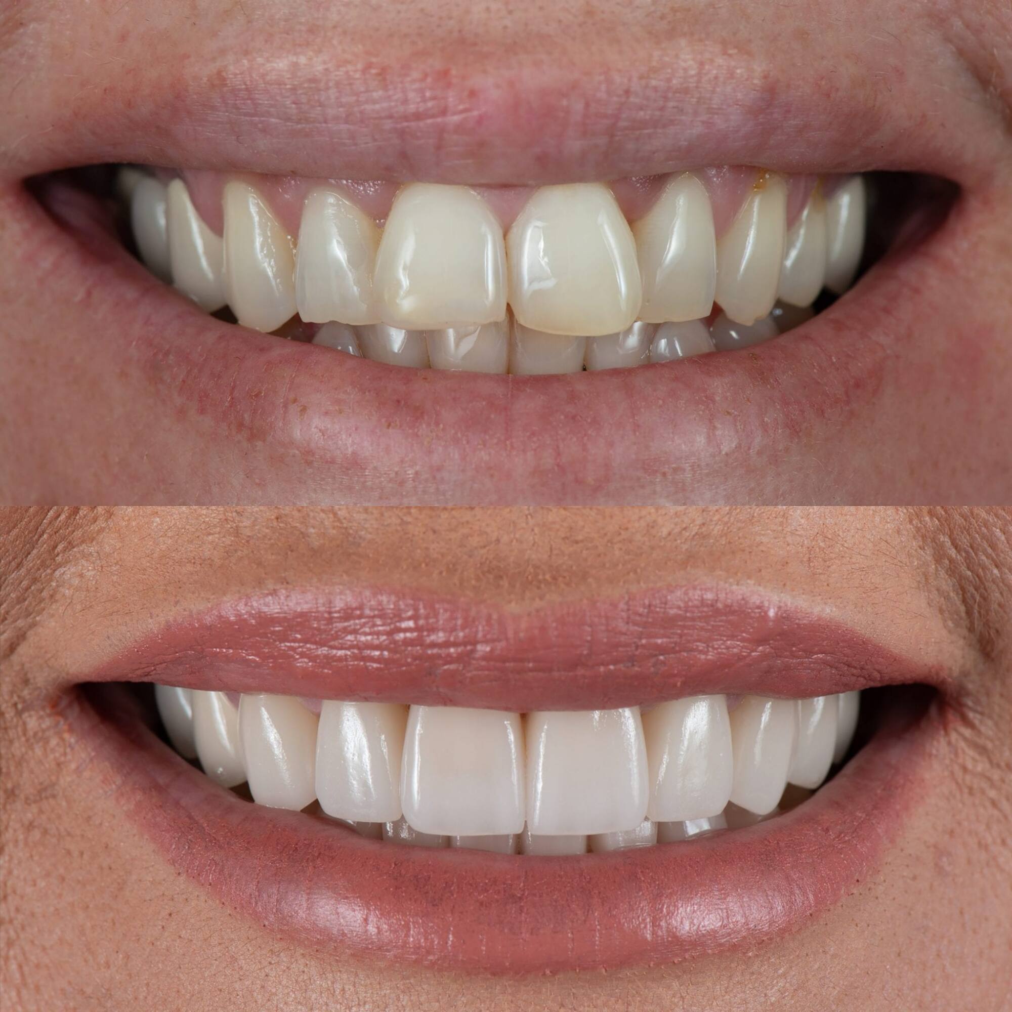 two images of teeths in comparision