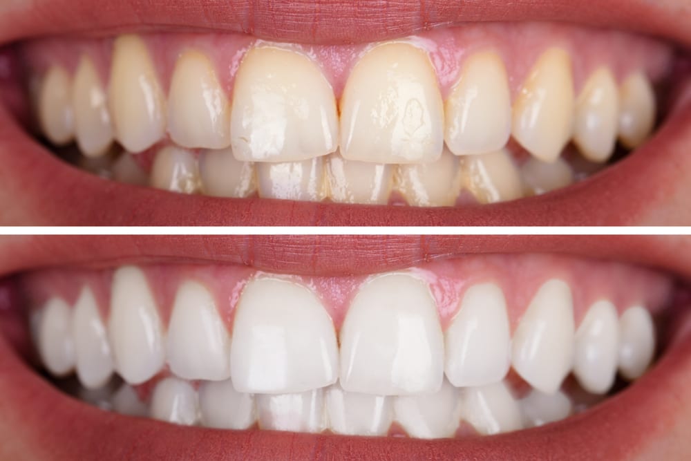 Teeth whitening